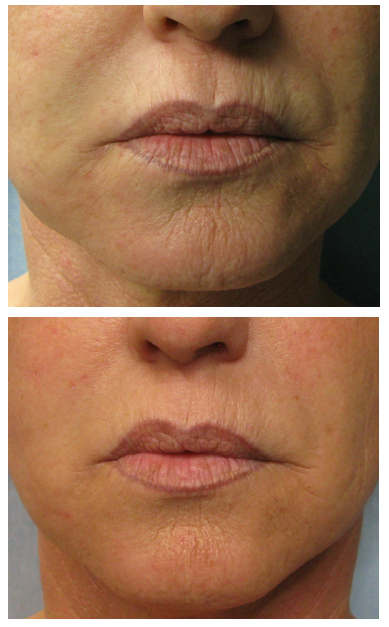 Mouth lines treated by Tixel