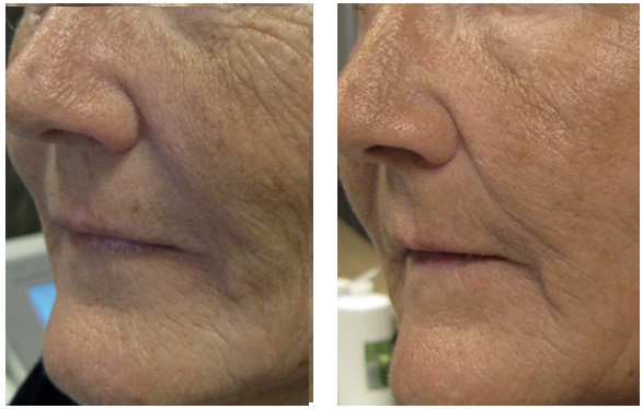 before and after Tixel