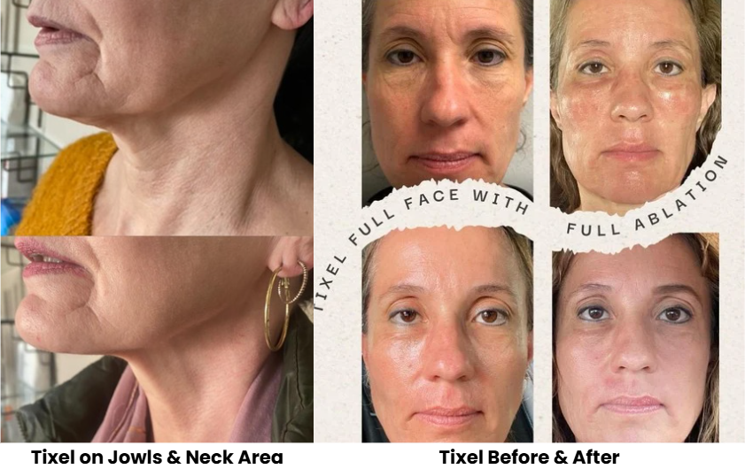 Experience Tixel Full Ablation