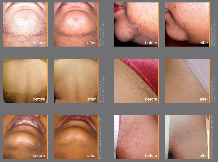 Nd Yag laser hair removal