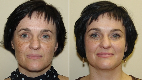 Limelight (YPL) treatment in Virginia, South Africa